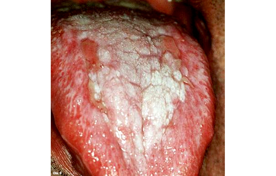 Obr. 6: Plak forma lichen planus s pridruženou parakeratózou a hyperkeratózou
