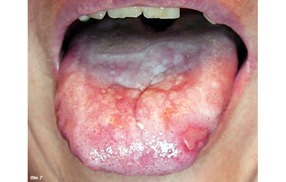 Obr. 7: Plak forma lichen planus na tele jazyka a erozívna forma na povrchu prednej tretiny