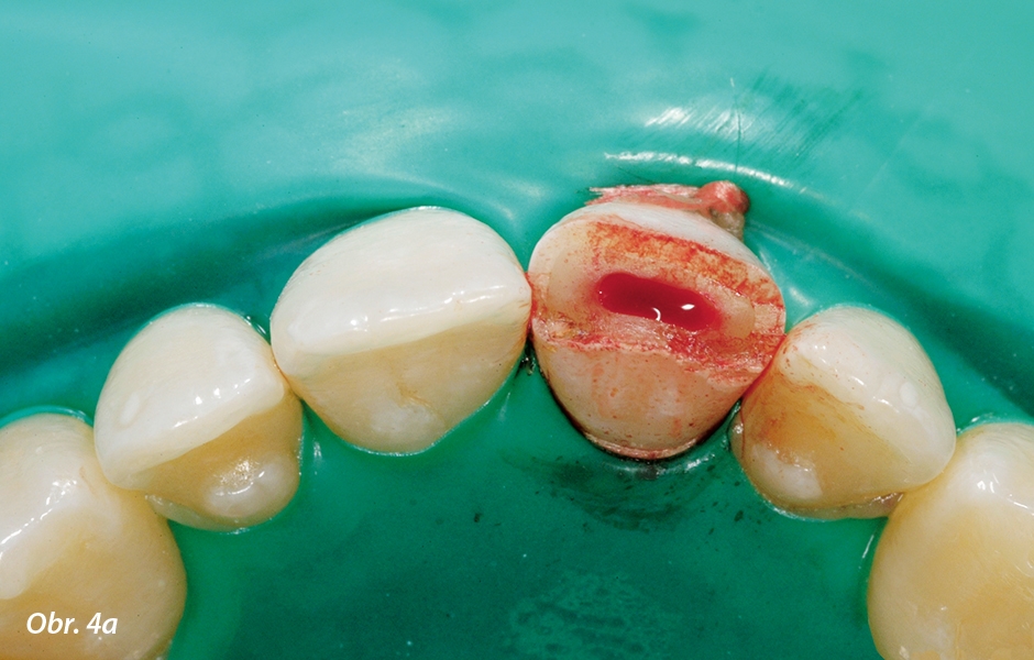  Došlo k ošetření kořenového kanálku, protože dřeň již byla vystavena prostředí ústní dutiny po dobu jednoho týdne.