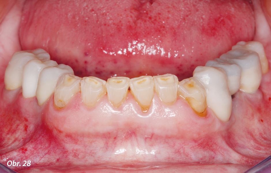 Dostavbou všech laterálních zubů dolní čelisti je dočasné zvýšení skusu již téměř dokončené.