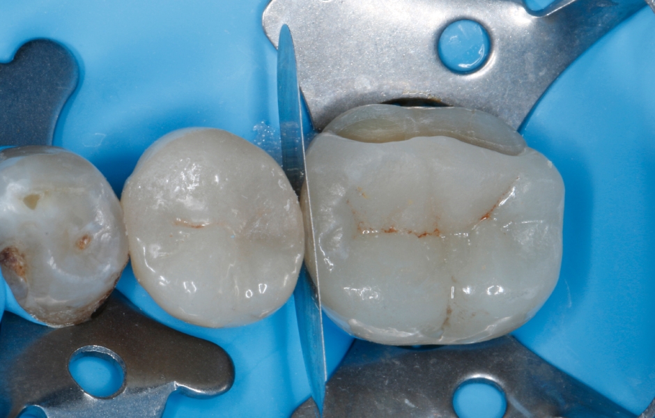 Do aproximálního prostoru byla umístěna kovová matrice na ochranu meziálního sousedního zubu před následným pískováním.