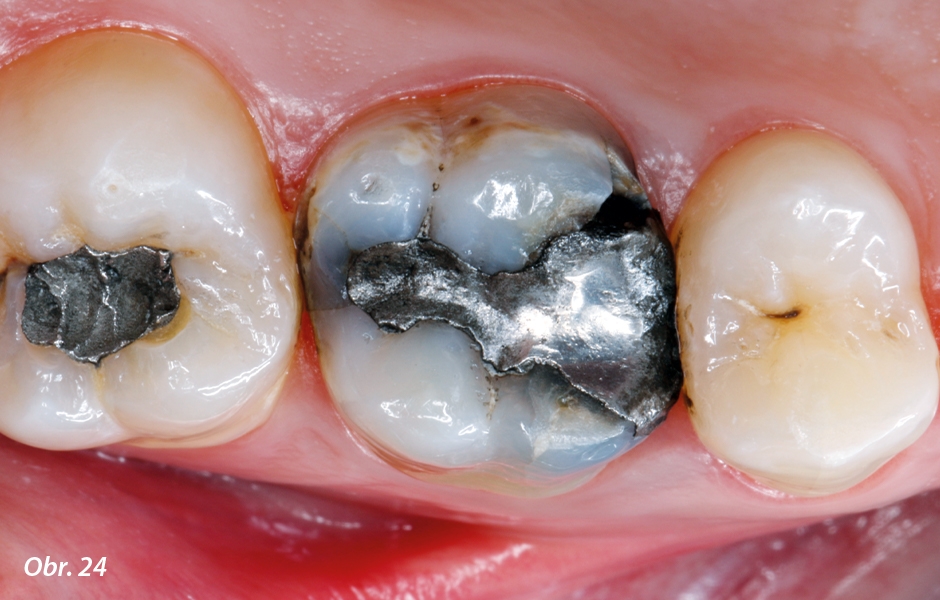 Výchozí situace: stará nevyhovující amalgámová výplň na zubu 16 (foceno přes intraorální zrcadlo)