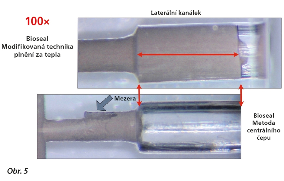 Test in vitro ukazující lepší pronikání sealeru do laterálního kanálku