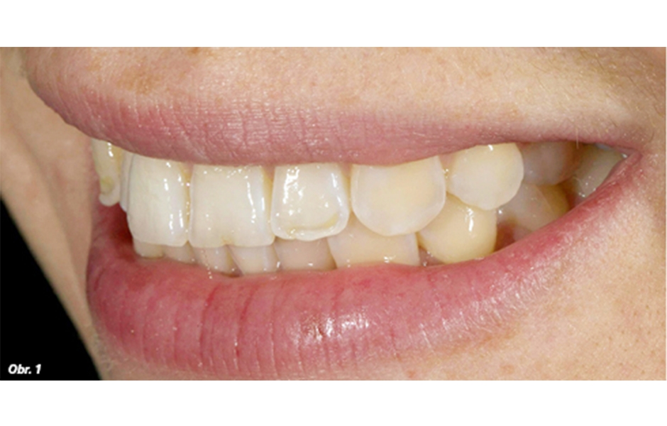 U pacientky byla zřejmá ztráta tvrdých zubních tkání vestibulárně s odhaleným dentinem