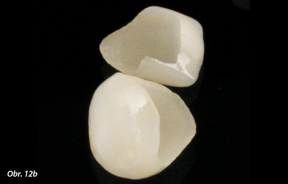 Adhezivní fixace rekonstrukcí na zuby v horní frontě