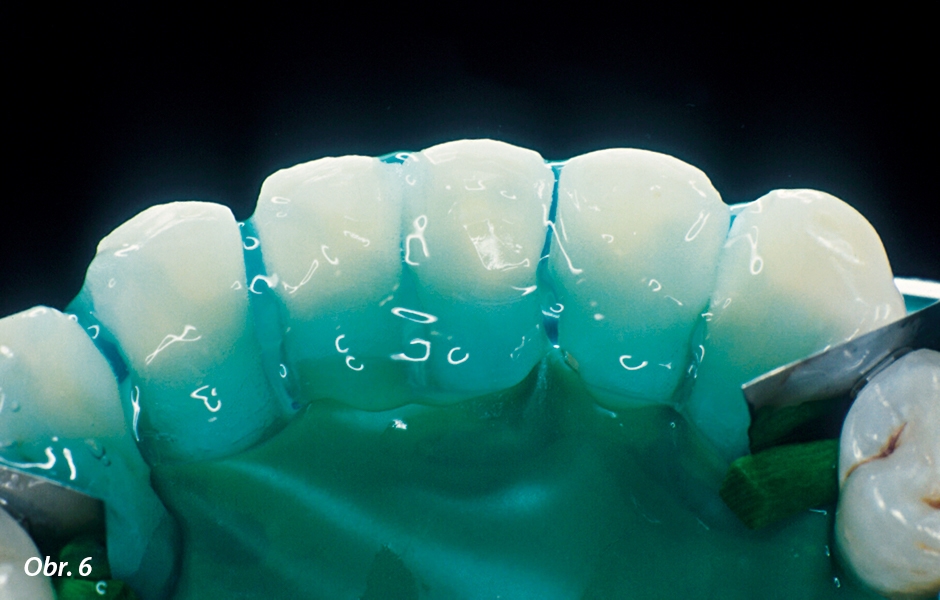 Zuby určené k dlahování byly naleptány po dobu 30 sekund gelem s kyselinou fosforečnou (UniEtch, Bisco), a to na lingválních a labiálních aproximálních ploškách
