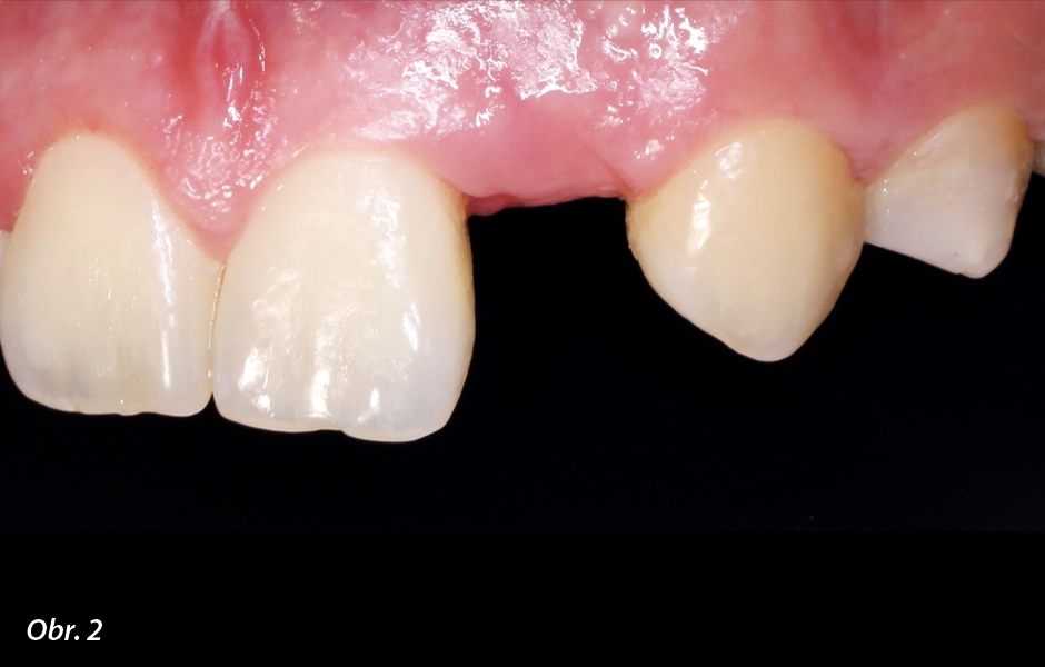 Horní zuby pacientky před ošetřením.