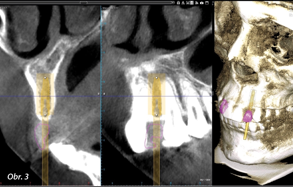 Digitální plánování implantátu a chirurgické šablony v softwaru Planmeca Romexis.