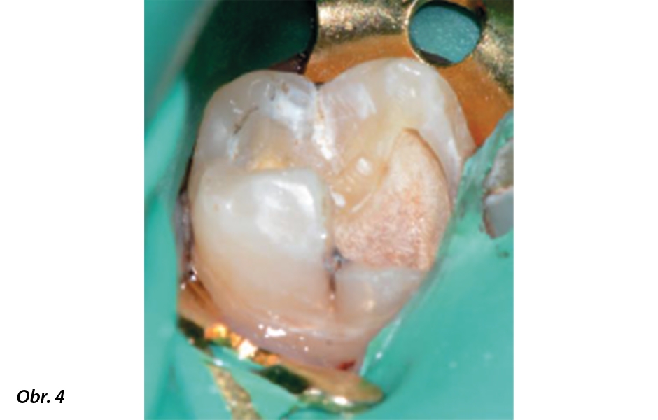 Obr. 4: Vzhled dentinu po ošetření ozonem a před zhotovením výplně. Vyšetření po 12 měsících ukázalo zachování vitality zubní dřeně.