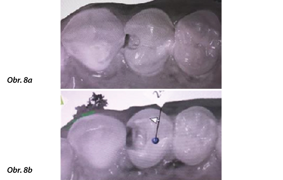 Obr. 8: a) Skenování zubu 24 bezprostředně po prvotní detekci kariézní léze. b) Sken zubu 24 po finálním odstranění kariézního dentinu za použití přípravku BRIX3000.