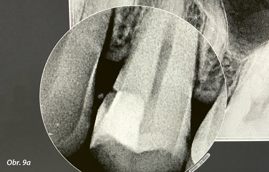 Obr. 9: a) RTG snímek zubu 24 po zhotovení výplně z materiálu BIO-DENTIN.