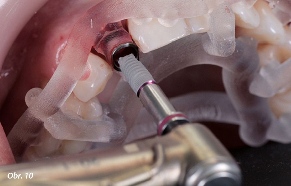 Zavádění implantátu (implantát NP, MIS) s chirurgickou šablonou.