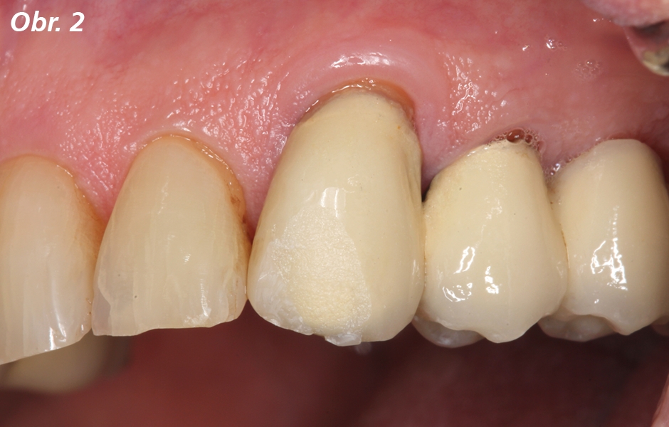 Detailní pohled na odlomenou oblast na zubu 23. Jedná se o tzv. jednoduché odlomení, při němž je postižena pouze keramika a nedošlo k obnažení kovové konstrukce