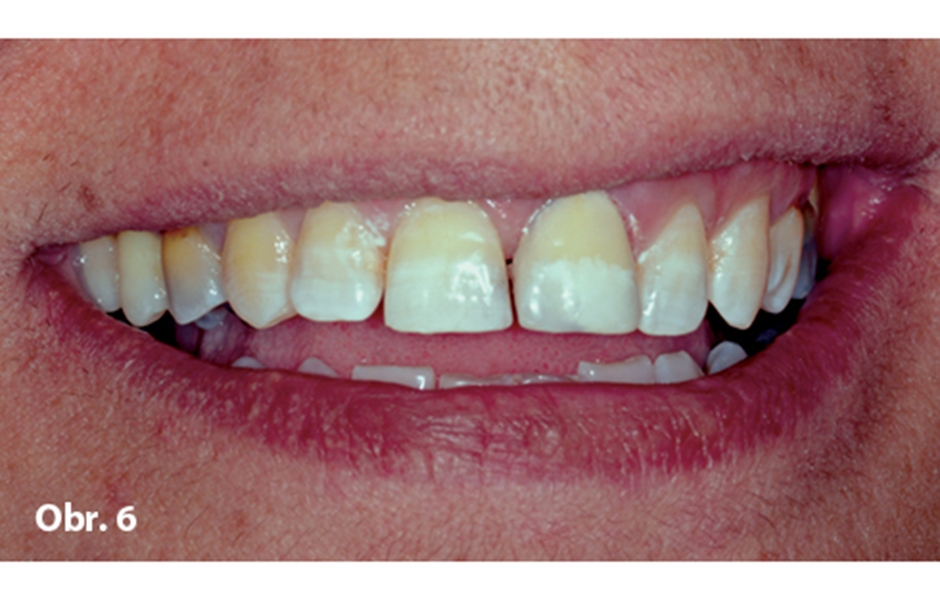 Obr. 6: Pohled na přímou kompozitní fazetu zubu 21 v plném úsměvu (ošetřující lékař: Dr. Husam abu Diab, Qalqiliya, Palestina)