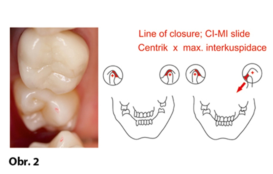 Obr. 2: Line of closure a arc of closure ukazují rozpor mezi centrální relací a okluzí v maximální interkuspidaci, kdy v takovém případě máme pouze jediný kontakt v „centriku”, tzv. „první kontakt”, zde konkrétně zub 17, bukální svah palatinálního hrbolku