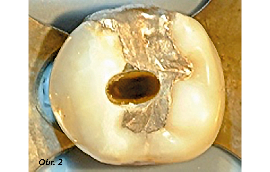  Příprava vstupů do kořenových kanálků – předpoklad úspěšné endodoncie