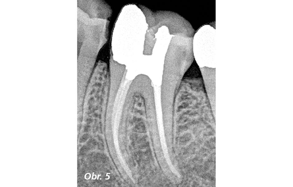 RTG snímek po ošetření dolního moláru ošetřovaného skrz meziální kariézní defekt a malý vstupní otvor ve středové jamce. Zachování dentinu mezi vstupními body je označováno jako „zpevňující“ přístupová konfigurace. (Fotografie: Dr. John Khademi)