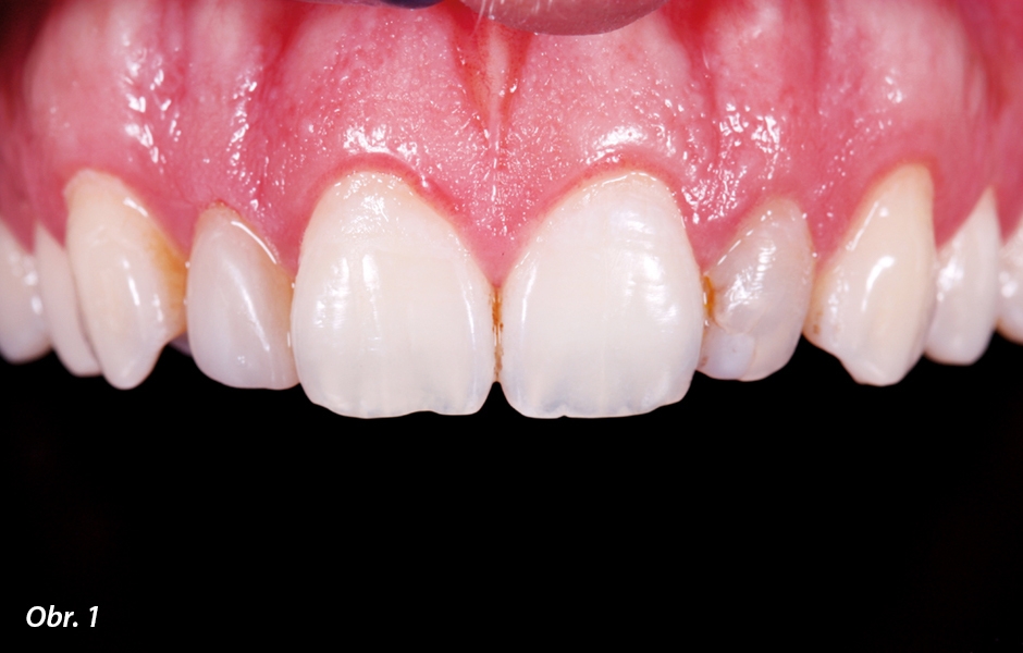 Původní situace: zub 22 je diskolorován z důvodu endodontického ošetření