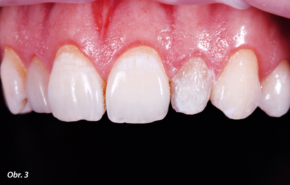 Preparovaný zubní povrch je překryt IPS Empress® Direct Color white