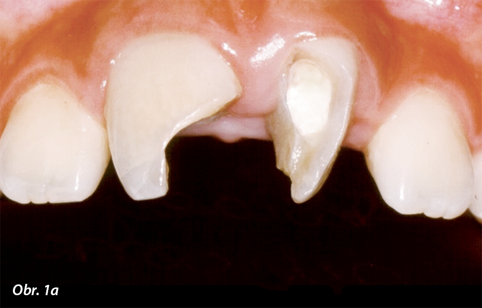 Fraktury v dentinu a sklovině korunek zubů 11 a 21 s intruzivním a rotačním posunem, související s předchozím akutním ošetřením. Pohled z bukální strany