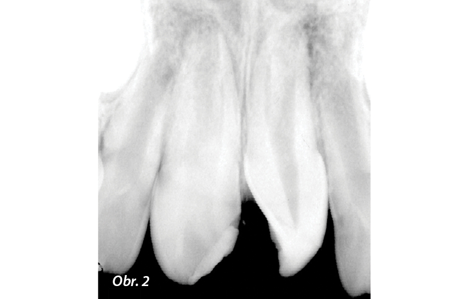 RTG snímek zachycující horní řezáky s traumatickou intruzí (zub 11) a intruzí a rotací (zub 21). Vidět je i neúplné vytvoření kořenů a otevřené apexy.