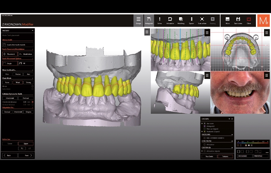 Funkce „multi-view“ v novém doplňkovém softwaru Zirkonzahn. Modifier umožňuje uživateli pohled na náhradu v různých pozicích, stejně jako na 2D snímky pacienta nebo 3D virtuální reprodukci fyziognomie pacienta.