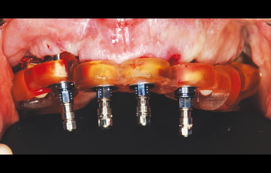 Obr. 14–15: Použití chirurgické šablony při zavádění implantátů.