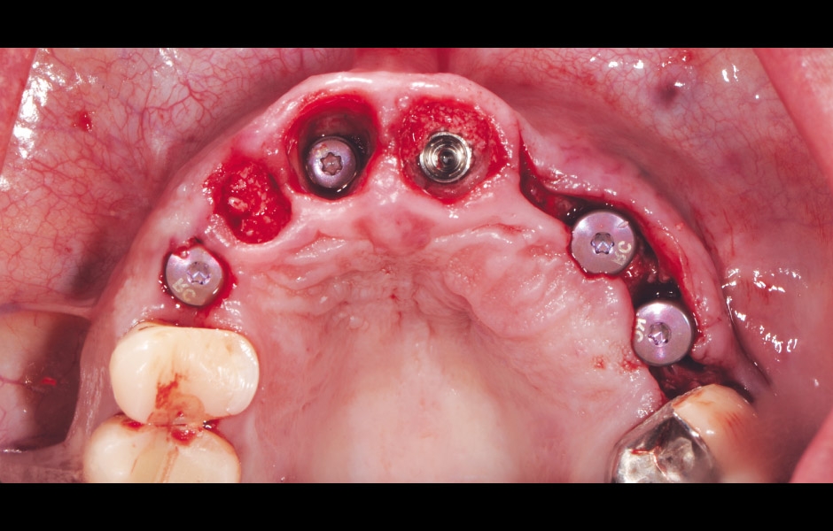 Obr. 16–17: Po inzerci implantátů a managementu měkkých tkání.