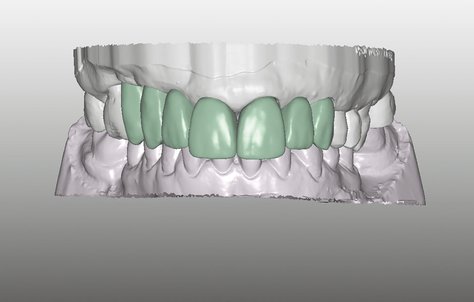 Obr. 29: Vytvoření ideálního poměru délky a šířky předních zubů.