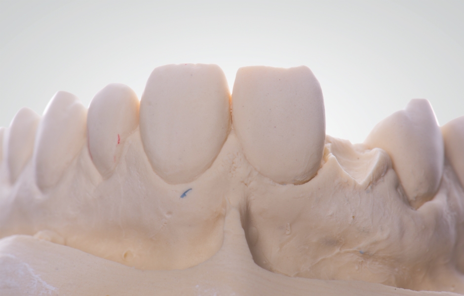 Pracovní model byl v místě mezičlenu upraven tak, aby na mukózní plošce nahrazovaného zubu vytvořil efekt vnoření do gingivy. Ve vestibulární oblasti je zapotřebí ponechat volný okraj gingivy k tomu, aby část tkáně mohla přilnout k mezičlenu.