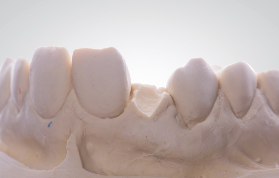 Pracovní model byl v místě mezičlenu upraven tak, aby na mukózní plošce nahrazovaného zubu vytvořil efekt vnoření do gingivy. Ve vestibulární oblasti je zapotřebí ponechat volný okraj gingivy k tomu, aby část tkáně mohla přilnout k mezičlenu.
