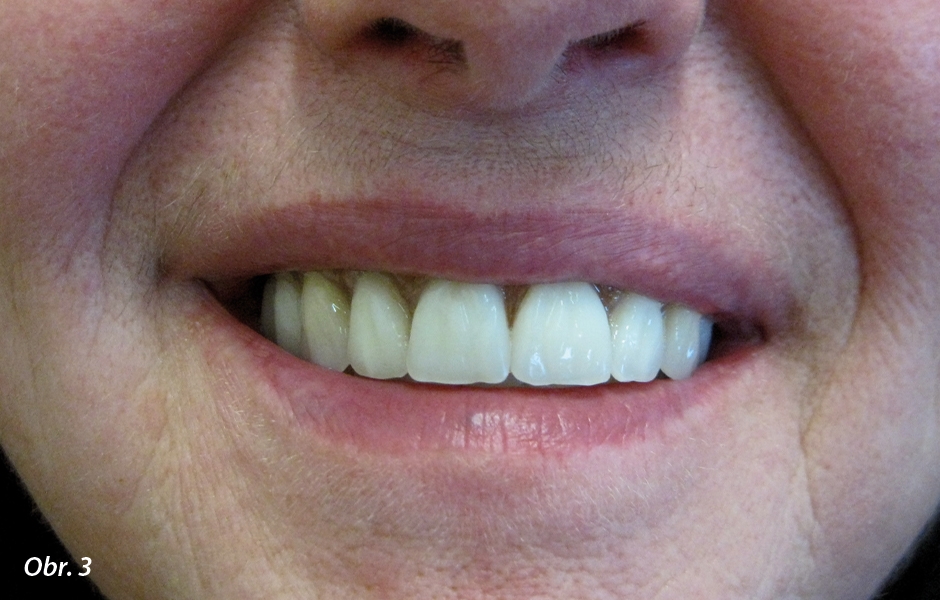 Nová zubní náhrada s individuálně upravenými zuby