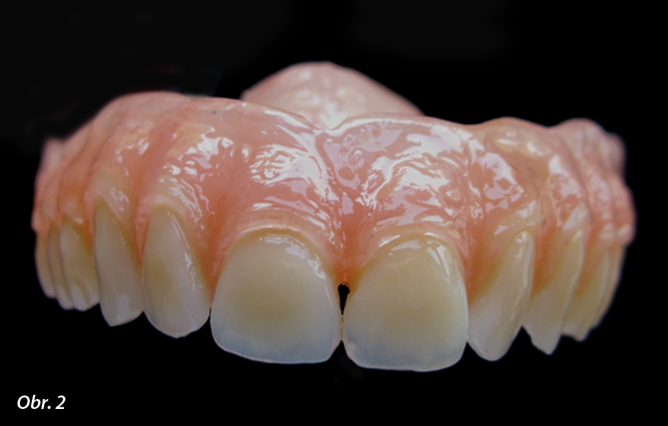 Náhrada zhotovená individuálně s přihlédnutím k původnímu postavení přirozených zubů – zuby jsou individuálně upraveny (Deflex M10)