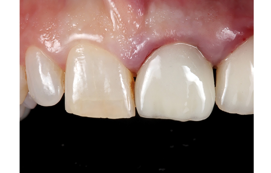 Obr. 1, 2: Výchozí situace: fraktura zubů 21 a 22. 