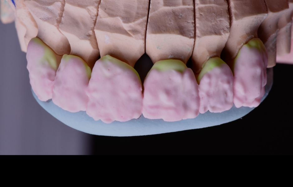 Obr. 8: Při nanášení dentinu se pomocí silikonového klíče kontroluje horizontální linie. 