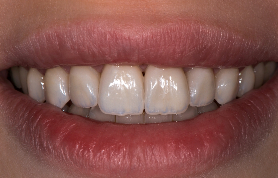Obr. 14: Věrná imitace výrazných struktur mamelonů přirozených spodních zubů.