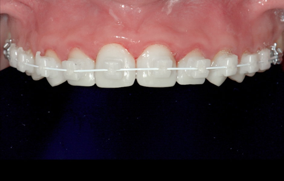 Obr. 2: Situace při ortodontické léčbě.