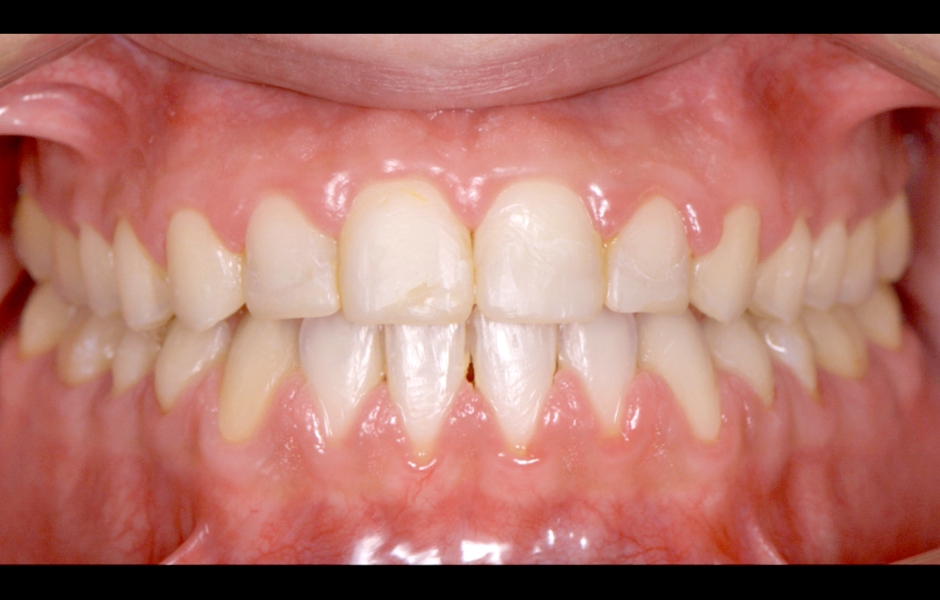 Obr. 3: Po ortodontické léčbě – výchozí situace pro protetickou rekonstrukci.
