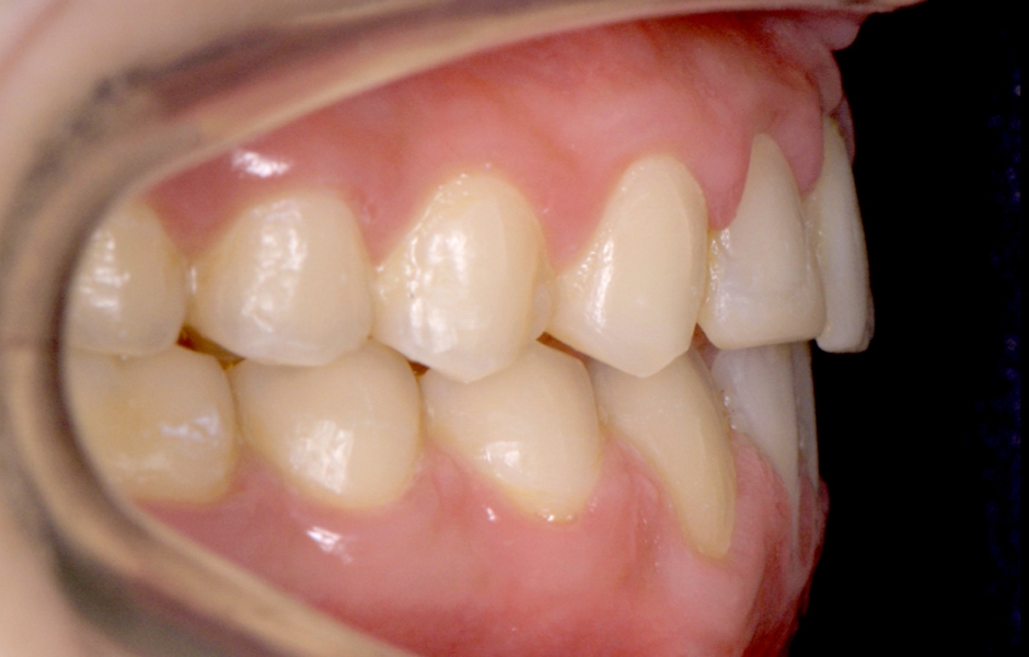Obr. 3: Po ortodontické léčbě – výchozí situace pro protetickou rekonstrukci.
