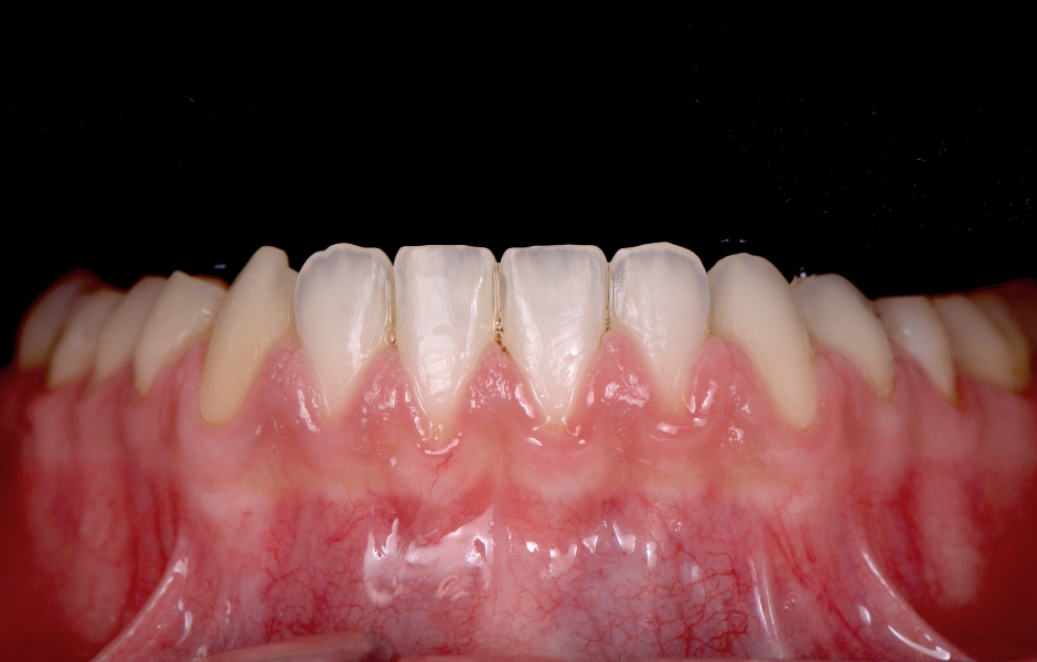 Obr. 4: Výrazná struktura mamelonů přirozených předních zubů v dolní čelisti, která musela být přesně napodobena.