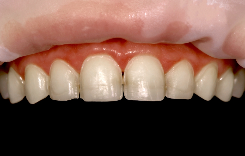 Obr. 5: Miniinvazivní preparace zubů 13 až 23 pro umístění celokeramických fazet.