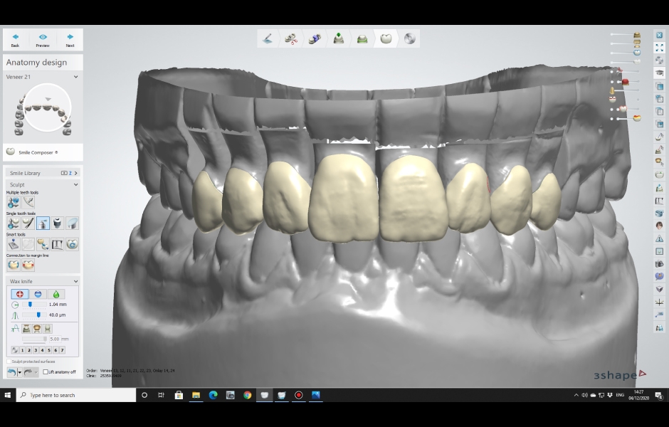 Obr. 6: Digitální wax-up v programu 3Shape Dental Designer.