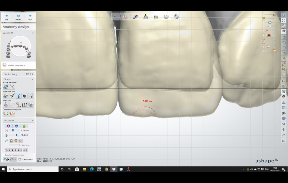 Obr. 7: Virtuální prodloužení zubů.