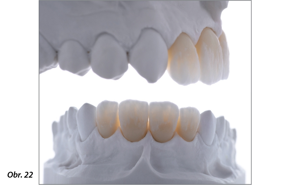 Obr. 22: Zdokonalování tvaru zubu před dalším pálením.