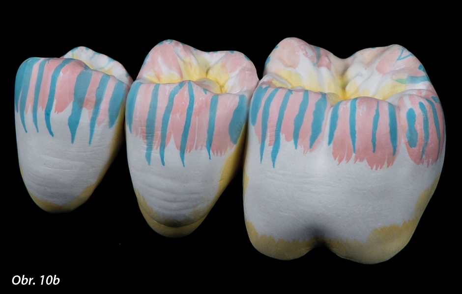 Dentin se nanáší dvakrát na aproximální a krčkové oblasti a na střední část okluzní plošky. Šedá a fialová se smíchají a nanáší na incizální třetinu a hřebeny hrbolků v rámci jednoho kroku. Nevzniká tak jednotně modrý efekt.