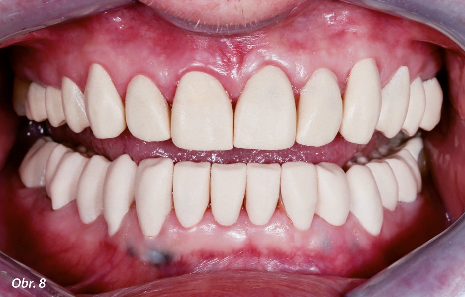 Fazety a částečné korunky vyfrézované z pryskyřičného bloku Try-In III v ústech pacienta.