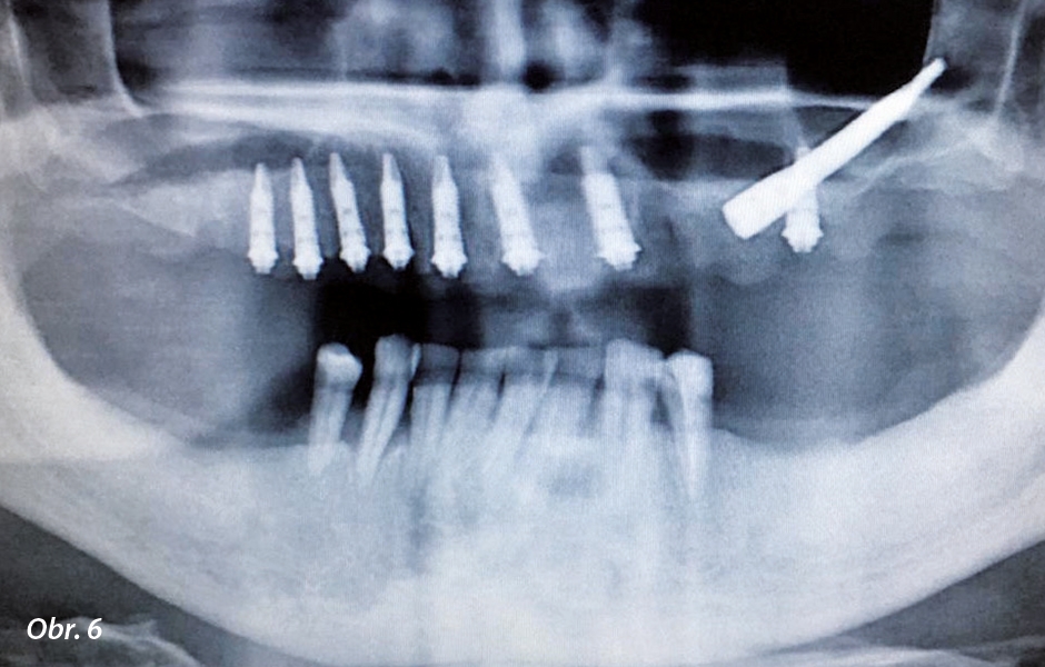 RTG snímek po zavedení implantátů.