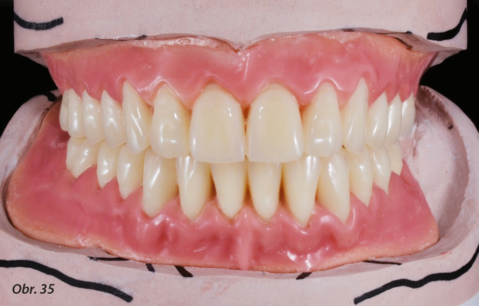 Diagnostický wax-up připravený na zkoušku v ústech. Wax-up umožní pacientce posoudit estetiku a rozměry náhrad. Meziálně nakloněný zub 37 a zuby v supraokluzi hovoří pro extrakci.