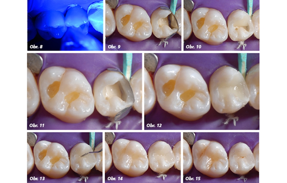 Zjednodušení výplňové techniky u distálních zubů díky Admira Fusion x-tra