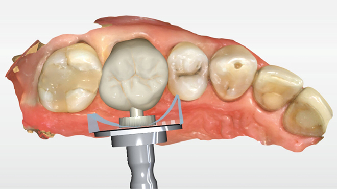 CEREC: Zirkonová korunka vyrobená za 82 minut